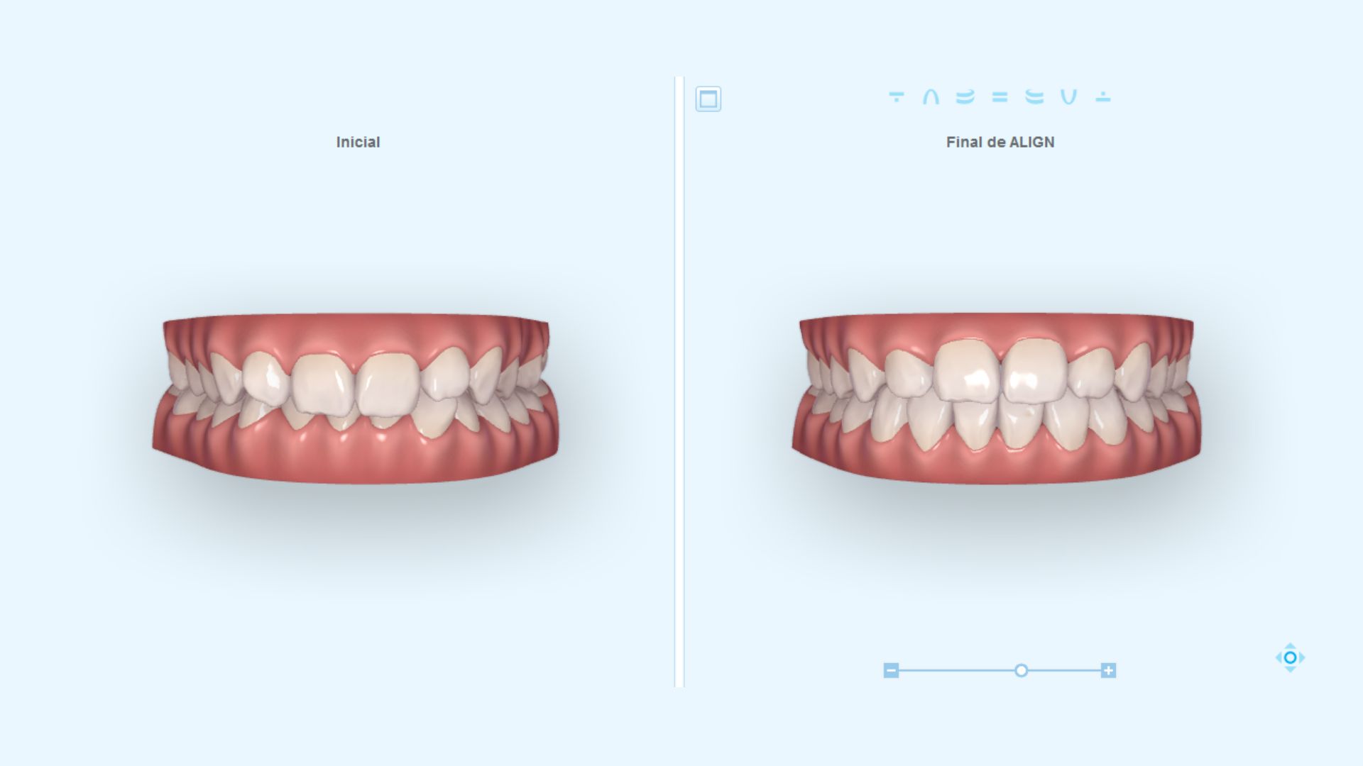 simulacion 3d invisalign