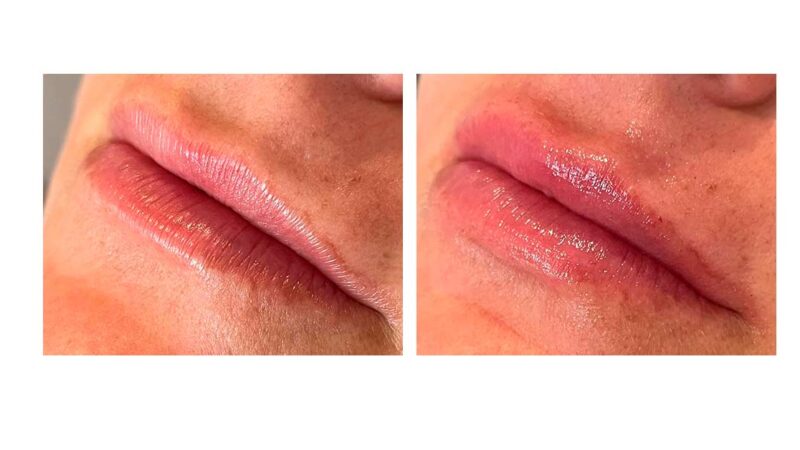 Aumento y perfilado de labios en el centro de Valencia