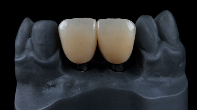 Implante dental con corona de zirconio en Valencia