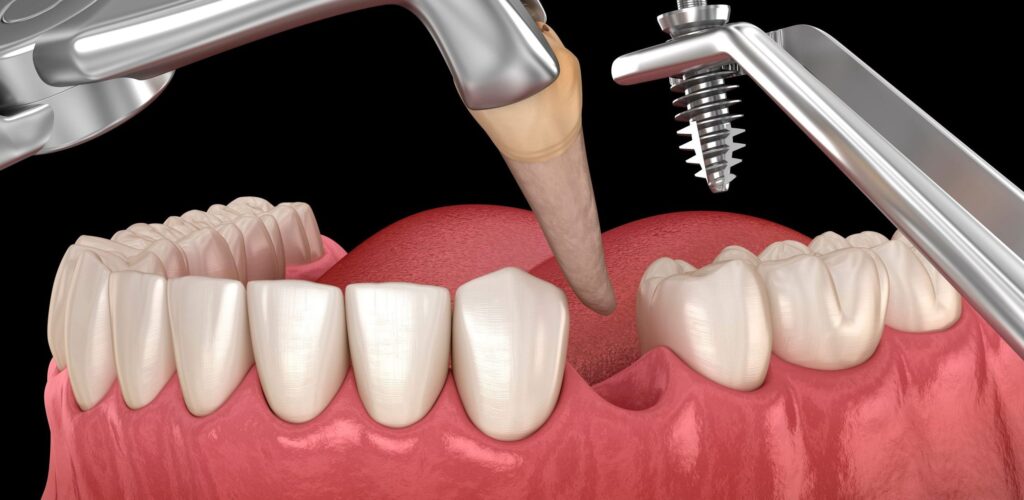 implantes de carga inmediata Valencia