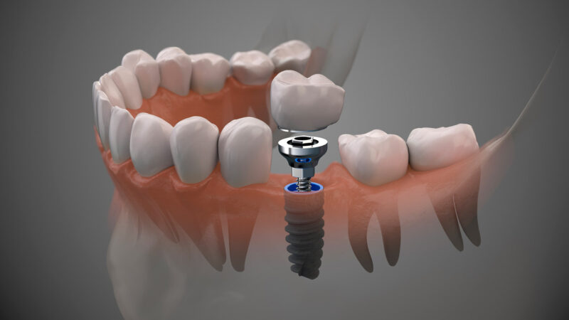 implantes de carga inmediata en Valencia