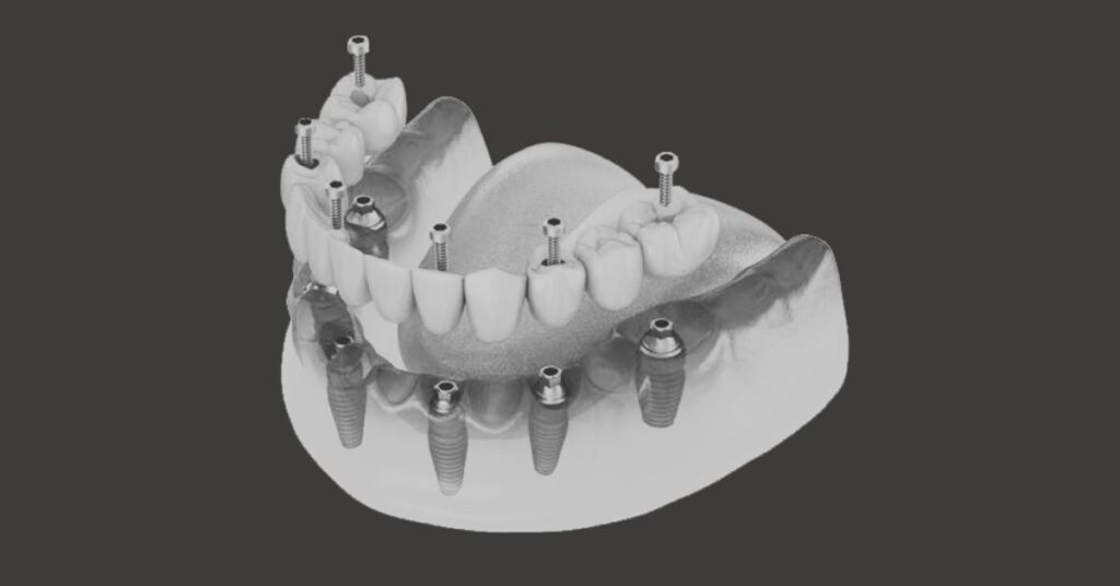 Dentista Especialista en Edentulismo en Valencia