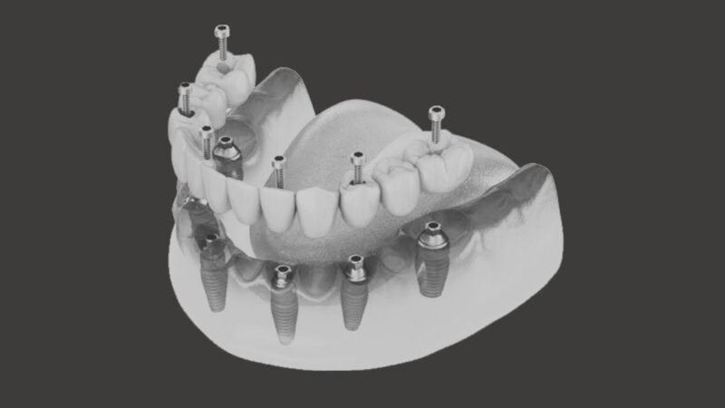 Dentista Especialista en Edentulismo en Valencia