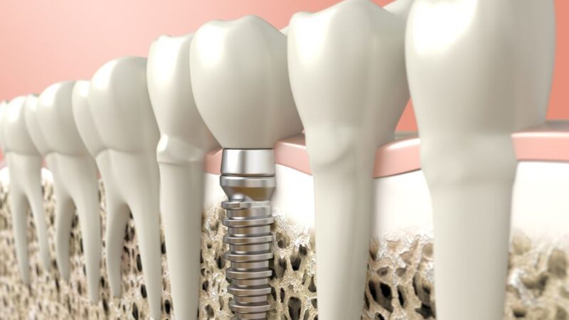 Implantes Inmediatos en Valencia