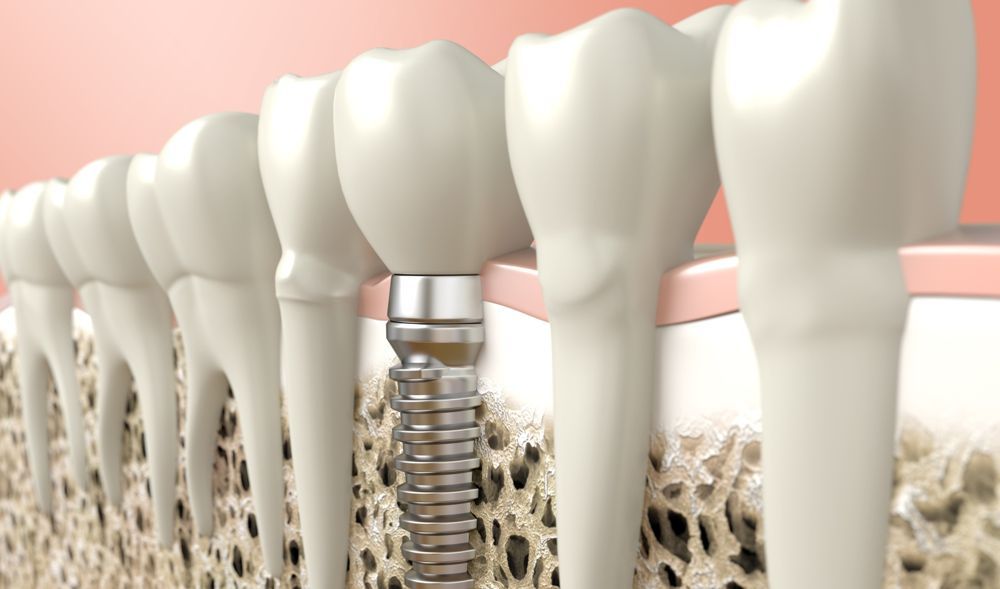 Implantes Inmediatos en Valencia